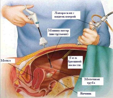 Фолликулярная киста яичника лечение симптомы при удаленном желчном пузыре
